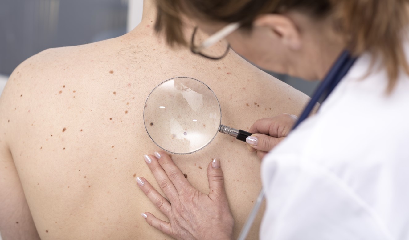 Skin Cancer